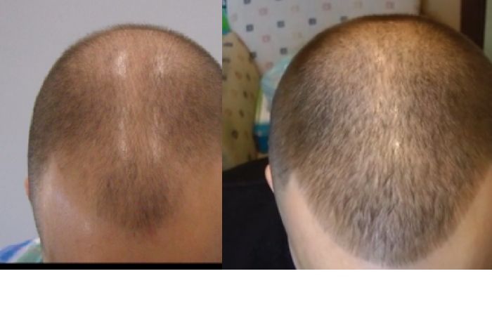 Форум после пересадки. Результаты после пересадки волос. До и после пересадки волос. Волосы после пересадки волос.
