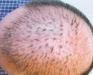 Пересадка волос: крушение иллюзий о факты