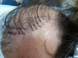 Голова после пересадкт волос