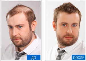 Как меняется внешний вид после установки системы замещения волос